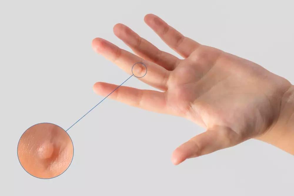 Cryotherapy / Electrosurgery – Wart Removal
